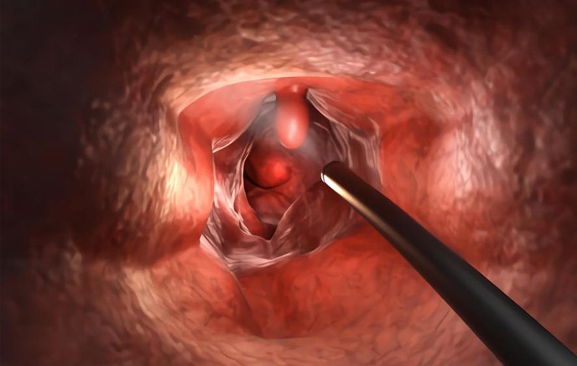 دانلود پاورپوینت پولیپ معده Stomach polyps چیست